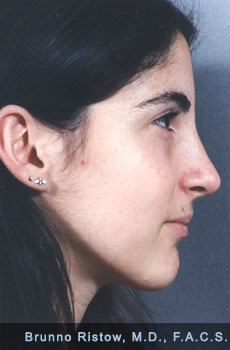 After Rhinoplasty (Nose) Plastic Surgery