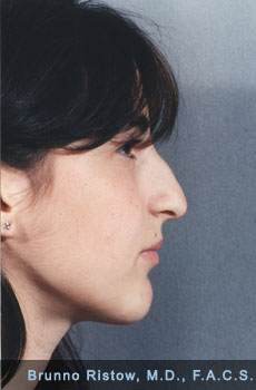 Before Rhinoplasty (Nose) Plastic Surgery