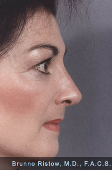 After Photo of Plastic Surgery - Septorhinoplasty