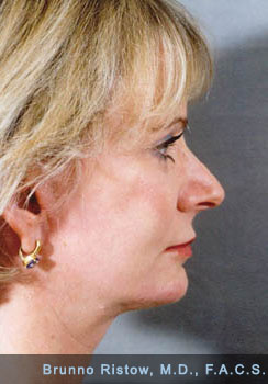 After Plastic Surgery Performed, Face, Neck Lower Eyelid Lifts Peri-Oral Dermabrasion