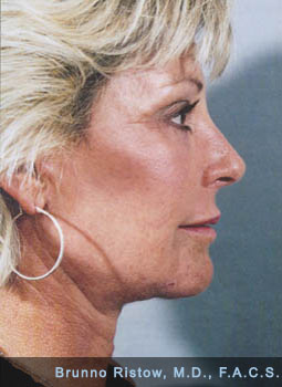 After Eye and Facial Cosmetic Surgery Performed by Dr. Brunno Ristow